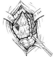 脾切除图片,关键步骤与术后护理